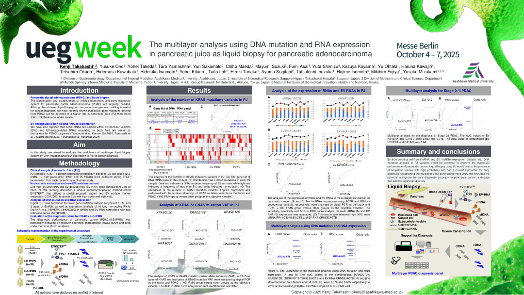 THE MULTILAYER-ANALYSIS USING DNA MUTATION AND RNA EXPRESSION IN PANCREATIC JUICE AS LIQUID BIOPSY FOR PANCREATIC ADENOCARCINOMA