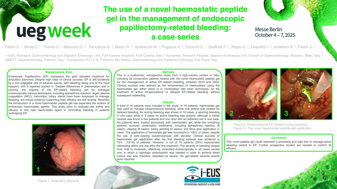 THE USE OF A NOVEL HEAMOSTATIC PEPTIDE GEL IN THE MANAGEMENT OF ENDOSCOPIC PAPILLECTOMY- RELATED BLEEDING: A CASE SERIES